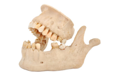 Tooth loss leads to jawbone loss. Grafting repairs the damage.
