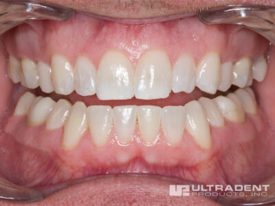 Boost tooth whitening effectively removes tooth stains.