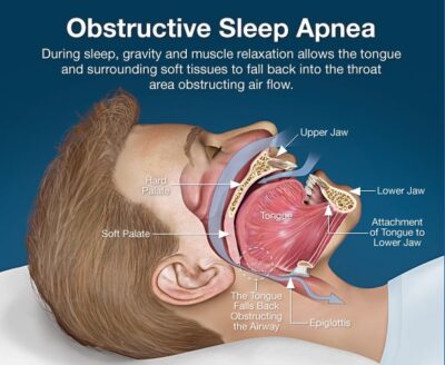 Sleep apnea is dangerous to your health. Our Placerville dentists can help.