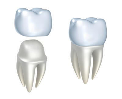 Crowns, inlays and overlays are provided by our Placerville dentists.