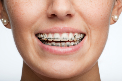 If You Wear Braces…