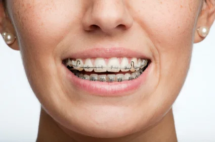 If You Wear Braces…