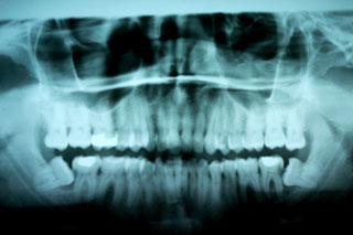 Wisdom Teeth X-ray, showing the danger of leaving impacted wisdom teeth in place.