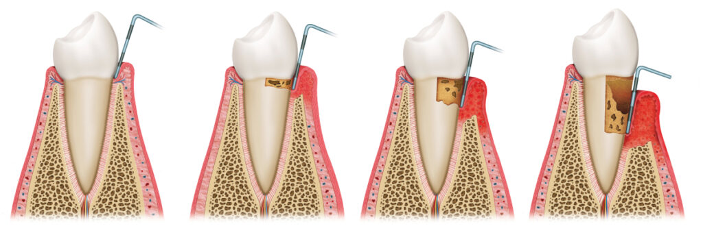 How to Fight Gum Disease