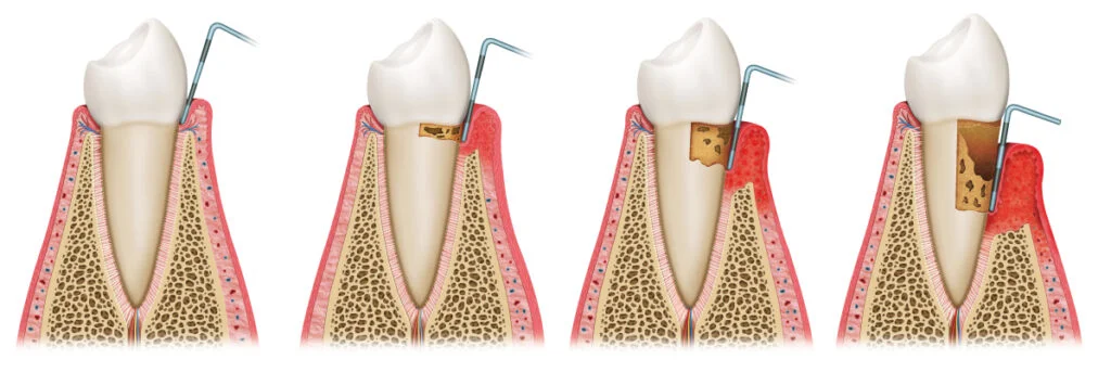 How to Fight Gum Disease