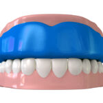 A customized mouthguard protects your teeth from outside forces and nightime or daytime teeth grinding.