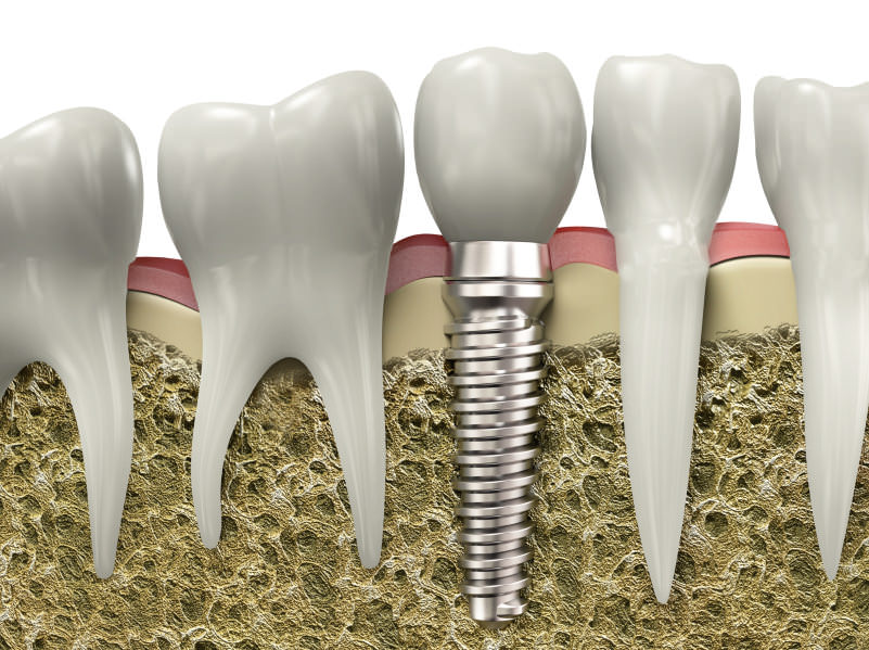 What To Do For Missing Teeth