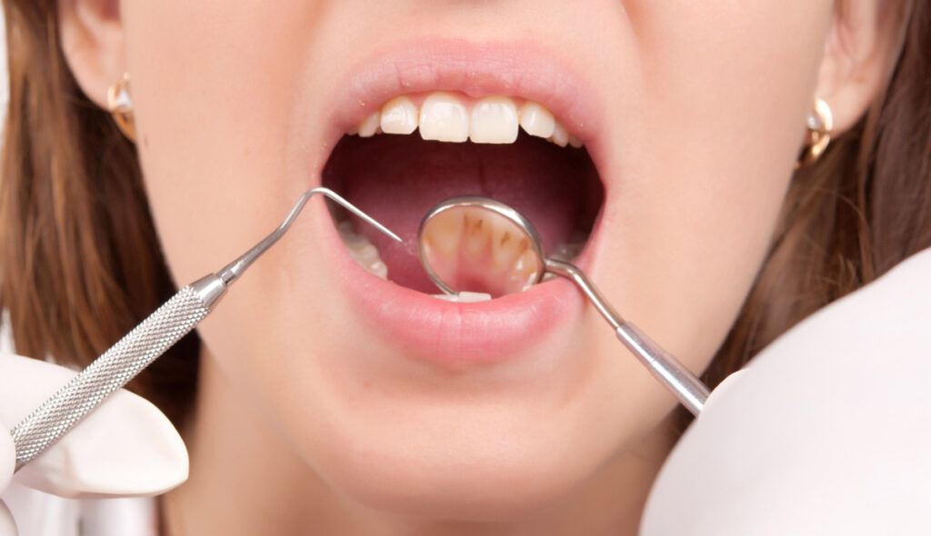 Avoiding Antibiotic Tooth Stains