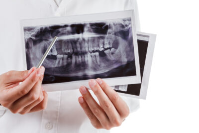 Full Mouth Restoration X-Rays
