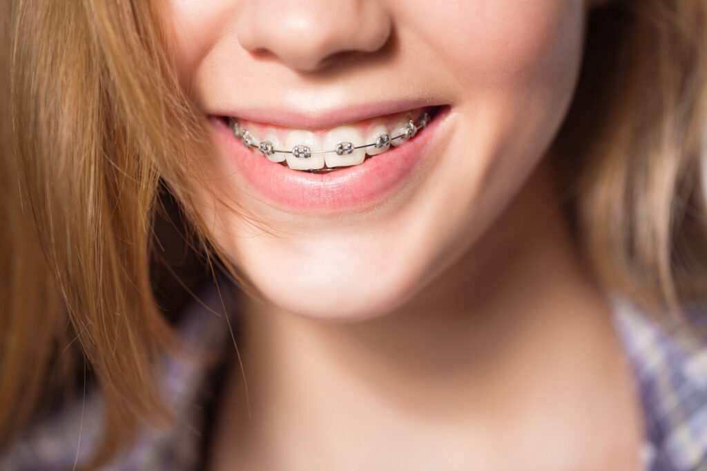 What Are Bonding Trays?