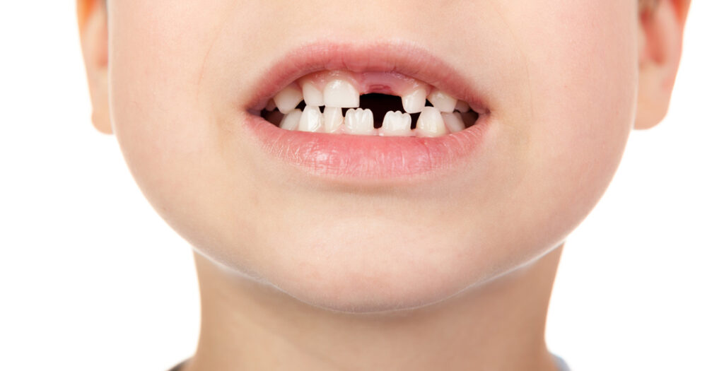 Why Do Children Have Jagged Teeth?