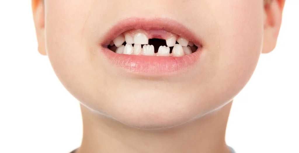 Why Do Children Have Jagged Teeth?