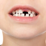 Jagged teeth are called mamelons and they do not require a visit to our Placerville dentists.