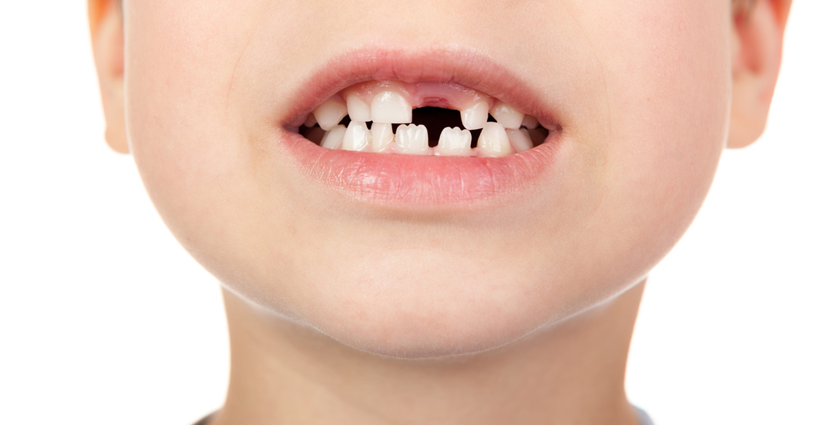 why-do-children-have-jagged-teeth-placerville-dental-group