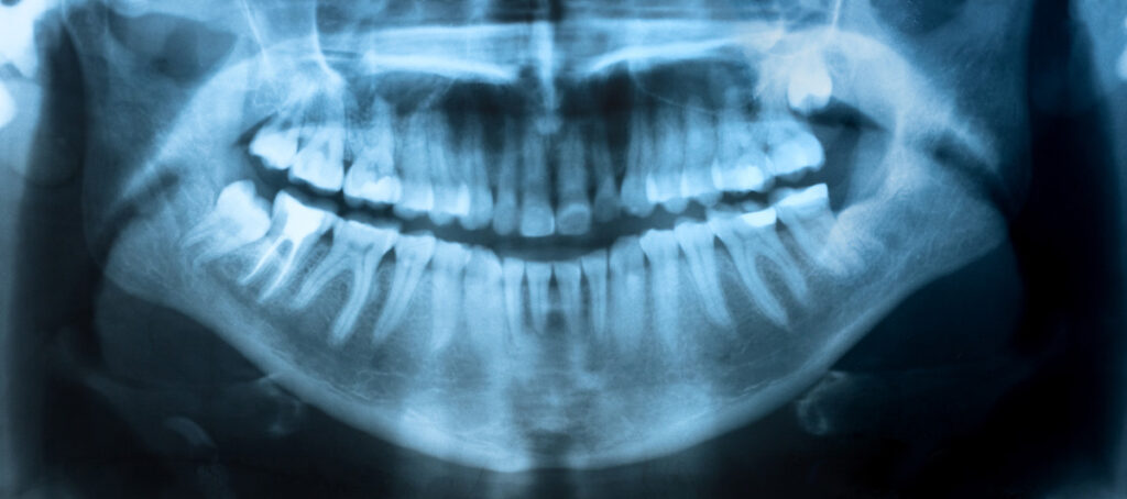 When to Extract Wisdom Teeth