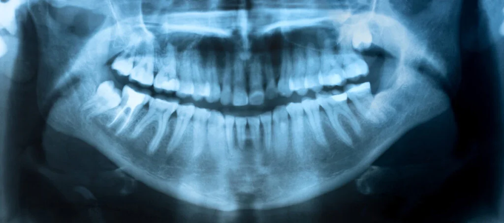 When to Extract Wisdom Teeth
