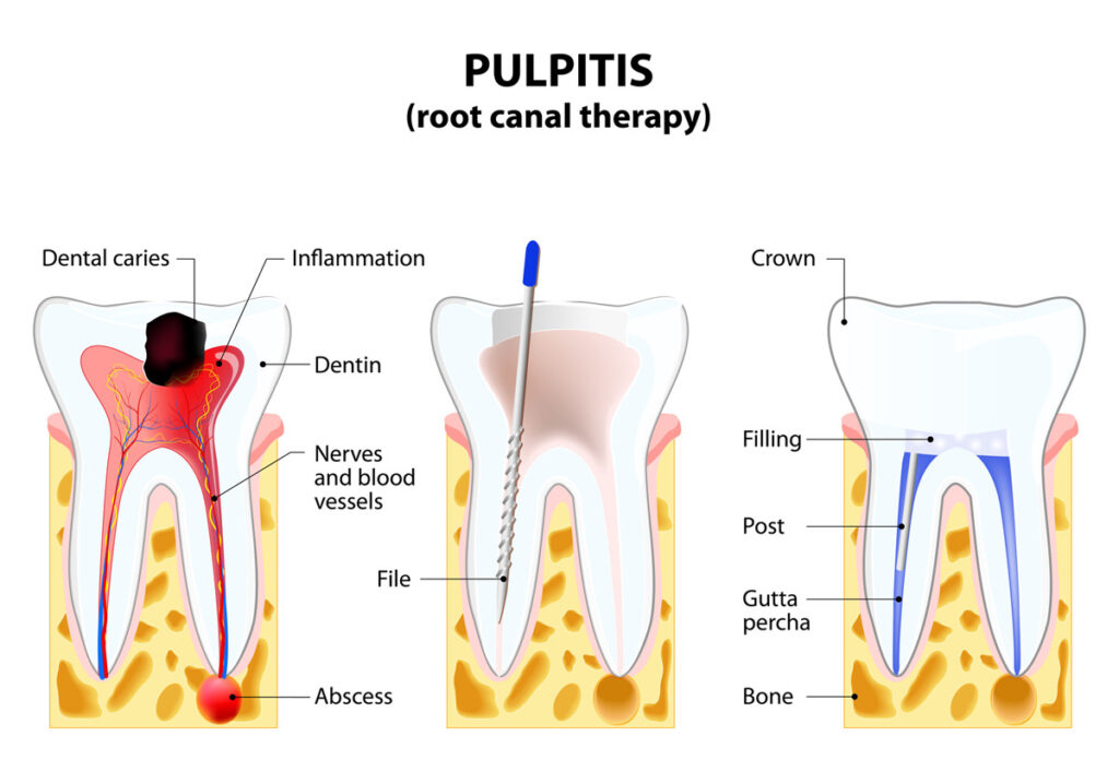 How to Know You Need a Root Canal
