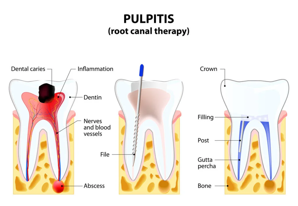 How to Know You Need a Root Canal