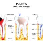 Our Placerville dentists perform root canals to save infected teeth.