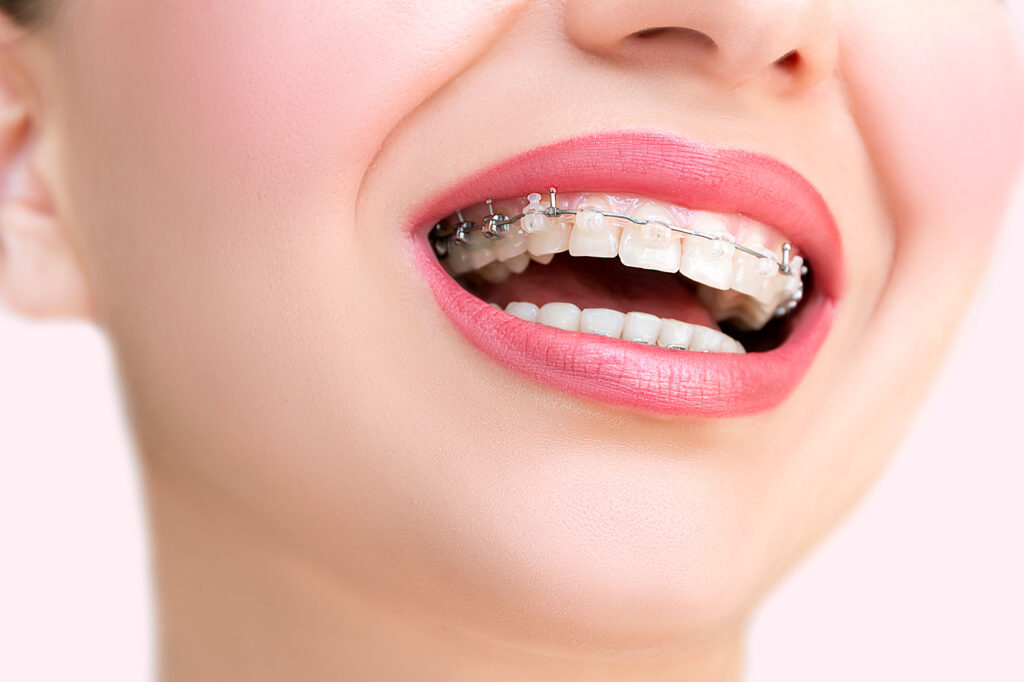 What Parents Should Know About Braces