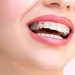 Close up Ceramic and Metal Braces on Teeth. Beautiful Female Smile with Self-ligating Braces. Orthodontic Treatment. 