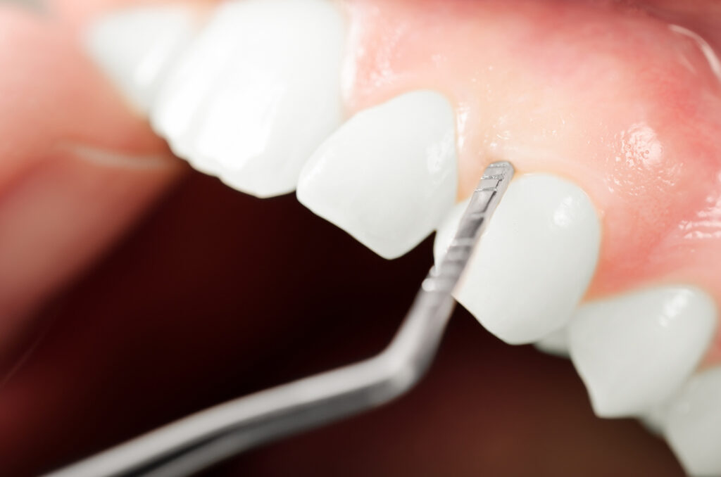 Tissue Issues and Pinhole Surgical Technique (PST)