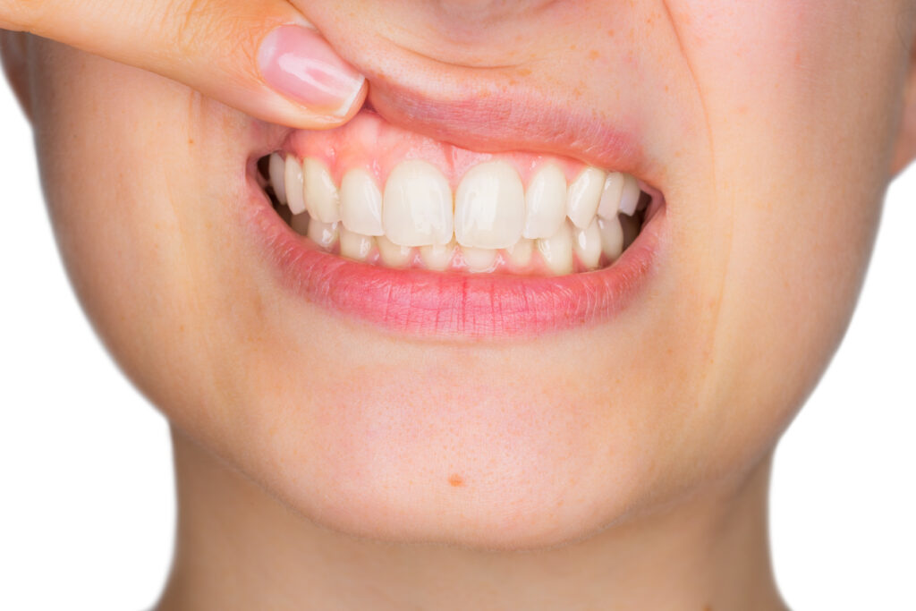 Does Gum Recession Affect You?