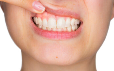 Does Gum Recession Affect You?