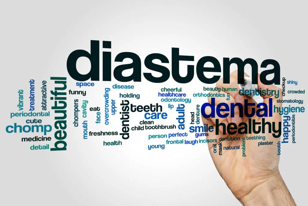 Dental Diastemas