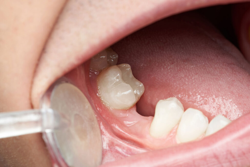 Dislodged Teeth