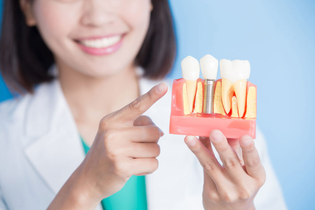 Bone Grafting for Dental Implants