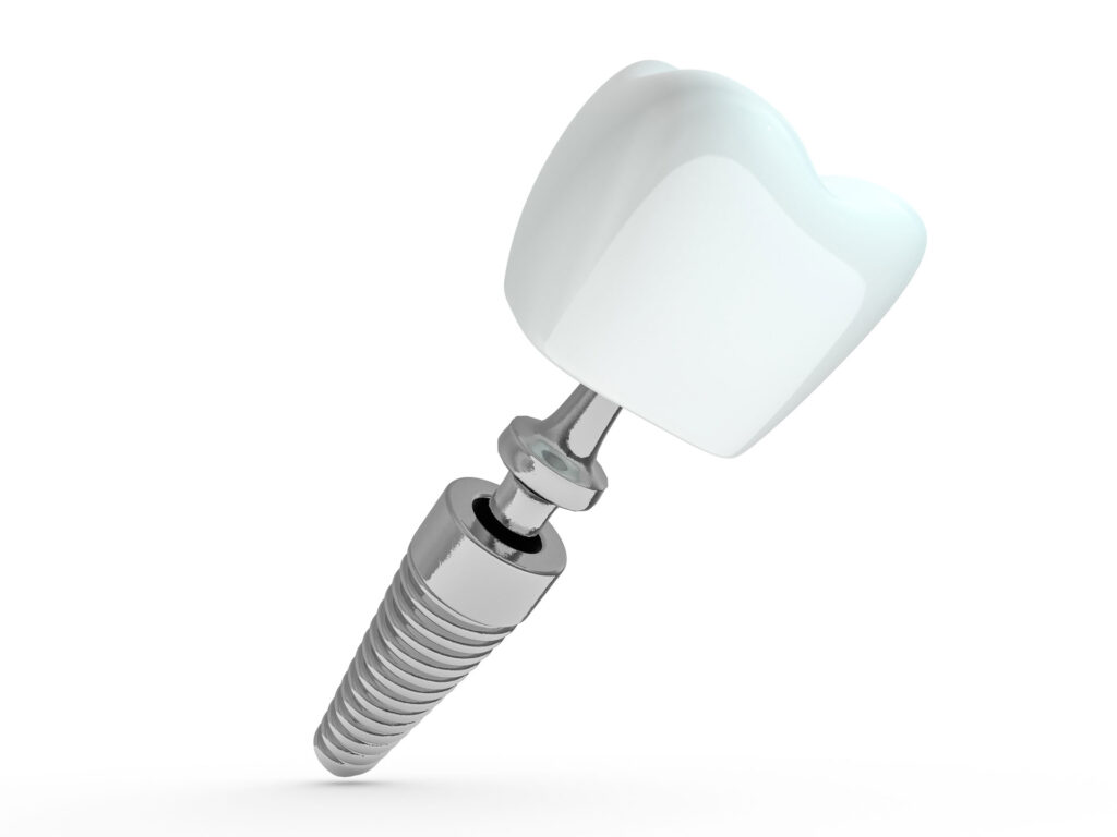 The Influence of Dental Implants