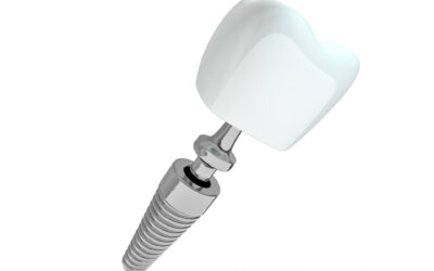 The Influence of Dental Implants