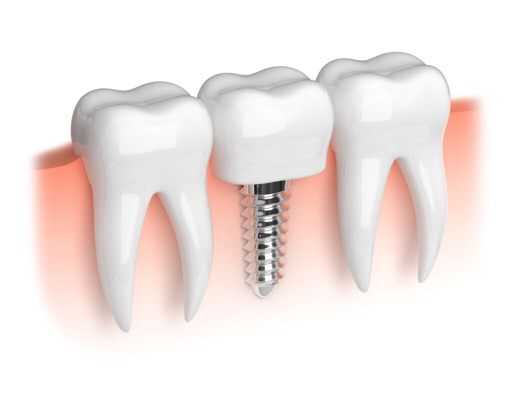 Sertraline and Dental Implants