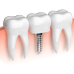 Dental Implants and SSRIs