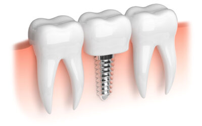 Sertraline and Dental Implants