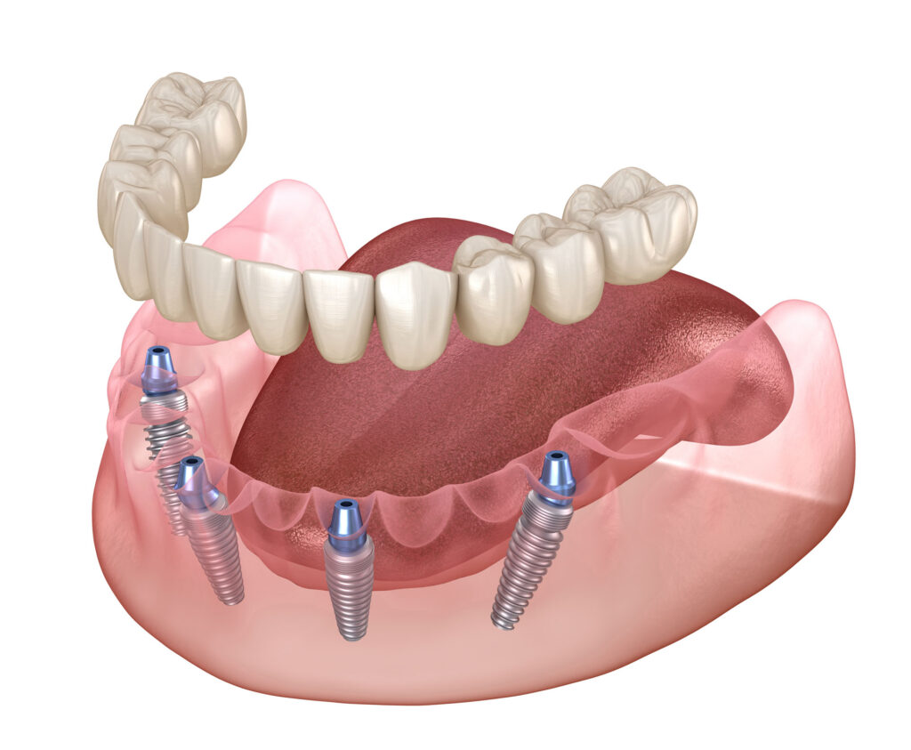 Five Benefits of Implant Dentures
