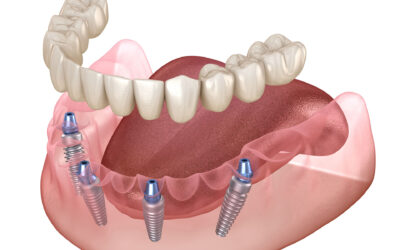 Five Benefits of Implant Dentures