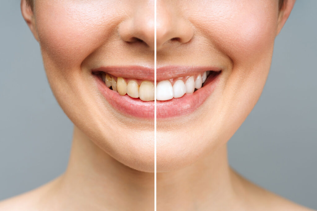 Yellow Teeth and Oral Health
