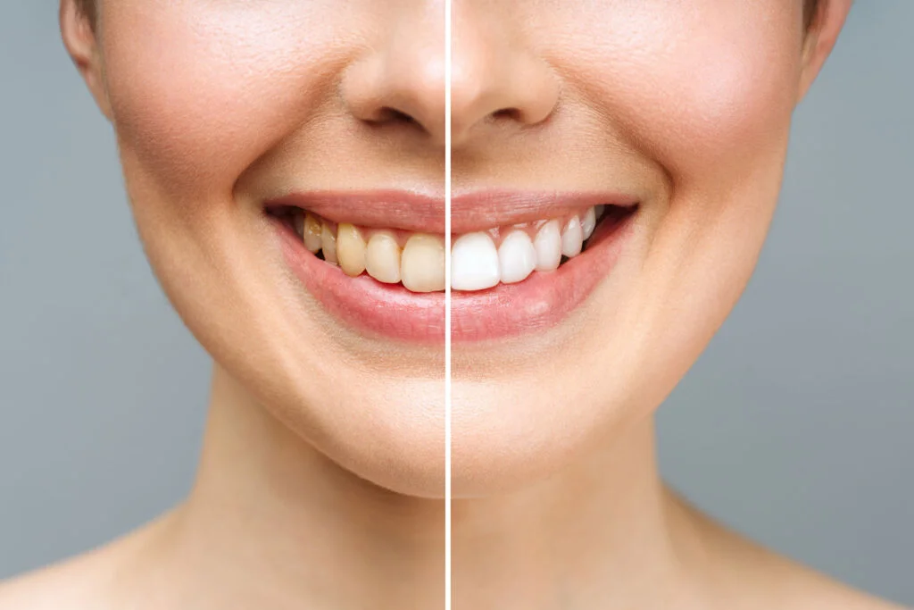 Yellow Teeth and Oral Health